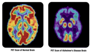 Photo comparing the PET scan of a normal brain to a brain of someone with Alzheimers 